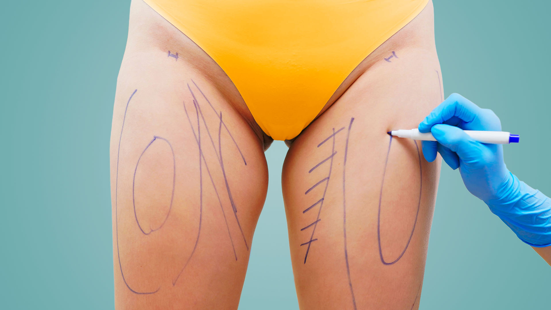 Lifting des cuisses à Lyon – dermolipectomie des cuisses Docteur Vlad Negulescu