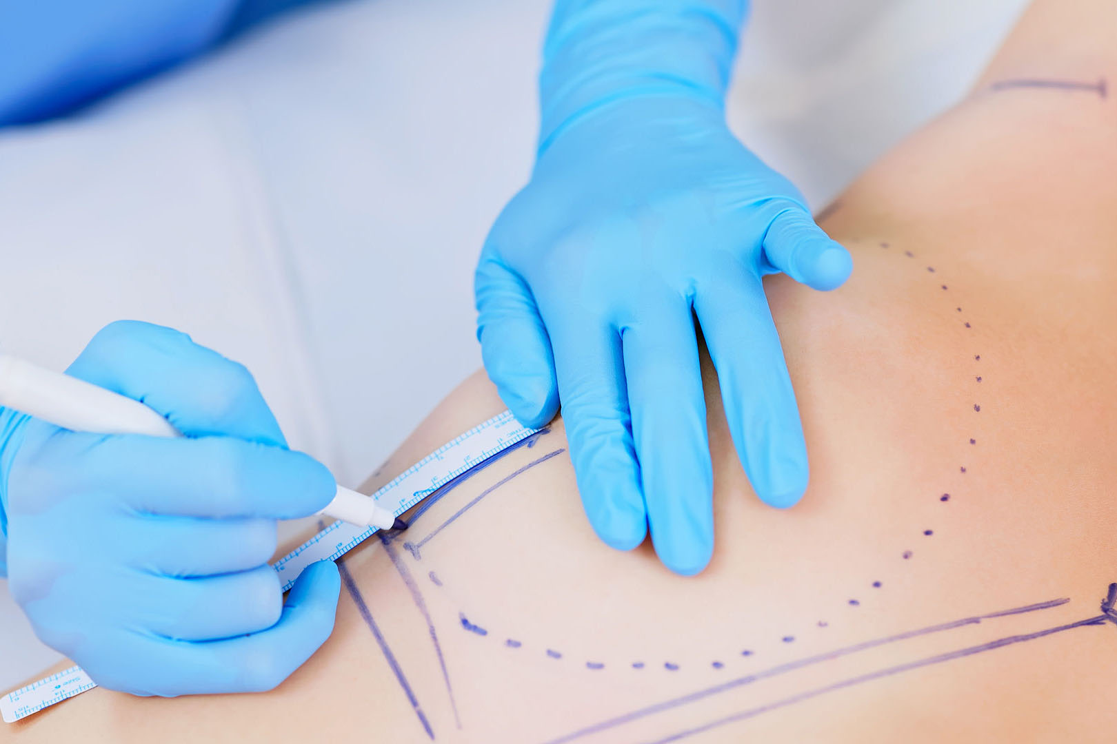 Reconstruction mammaire Lyon après cancer sein Docteur Negulescu