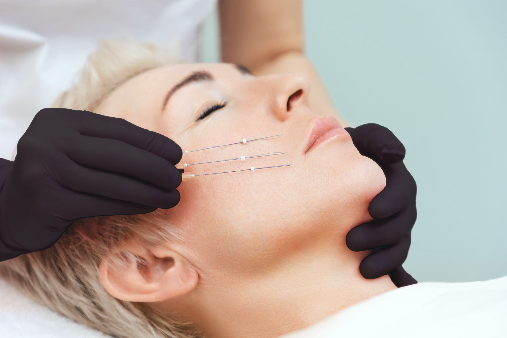 Fils tenseurs Lyon – lifting visage sans chirurgie Docteur Negulescu